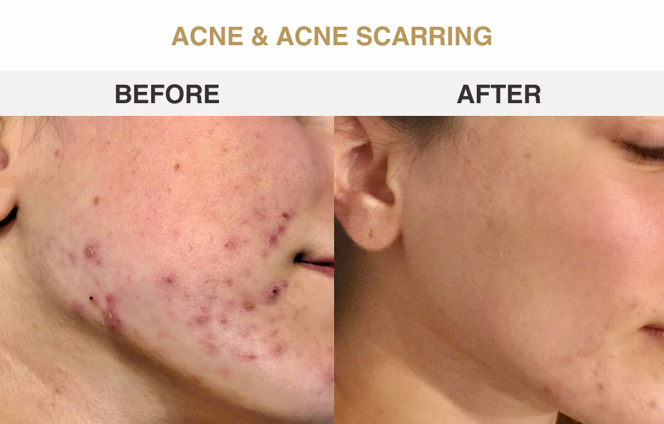 Acne and acne scarring before and after