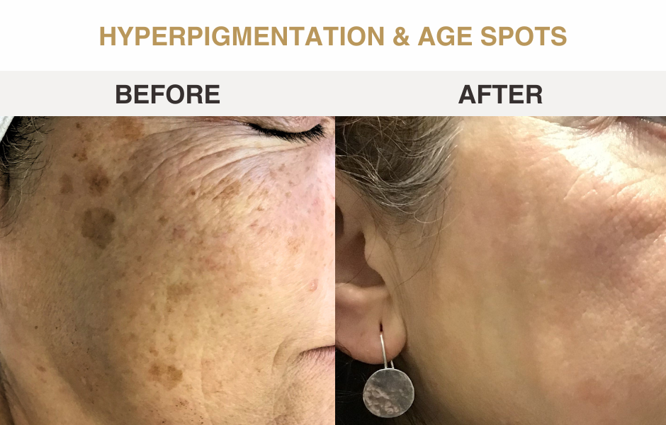 Pigmentation and age spots before and after