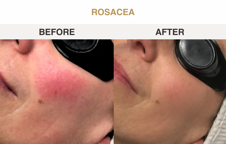 Rosacea before and after