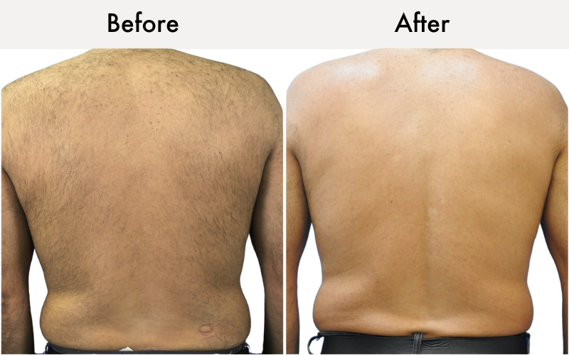 Men's back and shoulders before and after: Soprano Laser hair removal