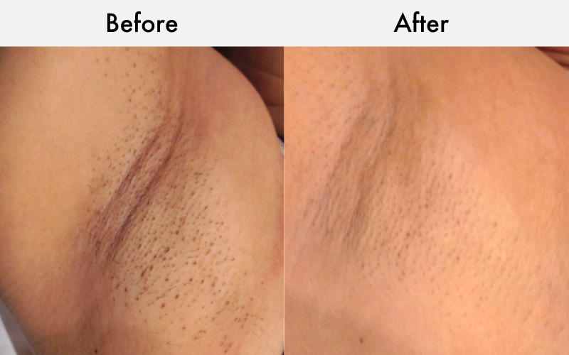Women's underarms before and after: Soprano Laser hair removal