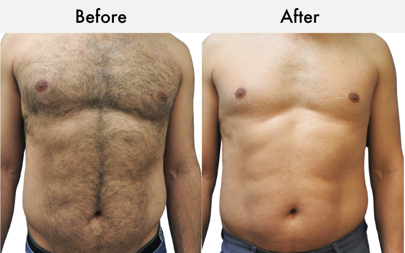 Men's chest and stomach before and after: Soprano Laser hair removal